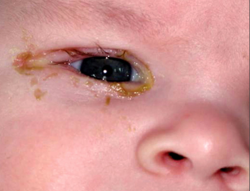 Что такое конъюнктивит глаз у детей: виды, причины возникновения