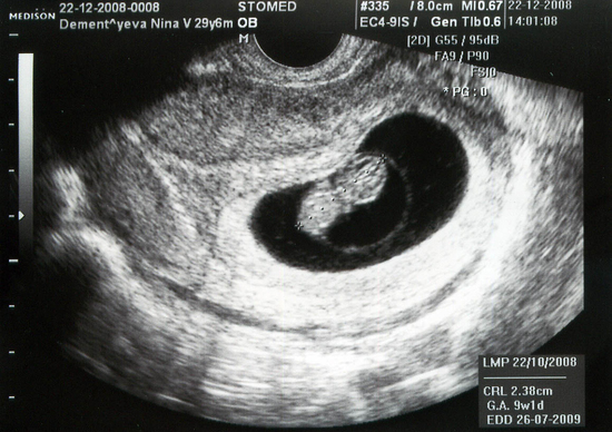 Эмбрион на седьмой неделе
