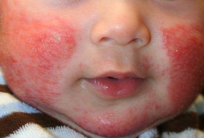 Как долго не проходит аллергия на коже