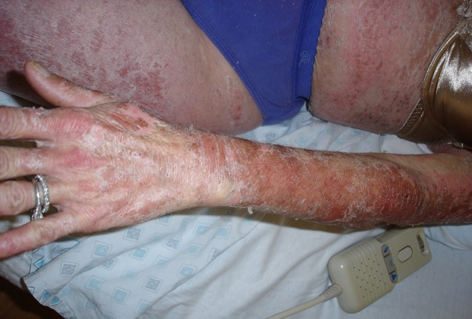 Как долго не проходит аллергия на коже