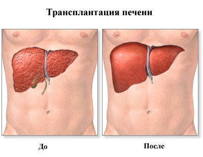 liver-t1