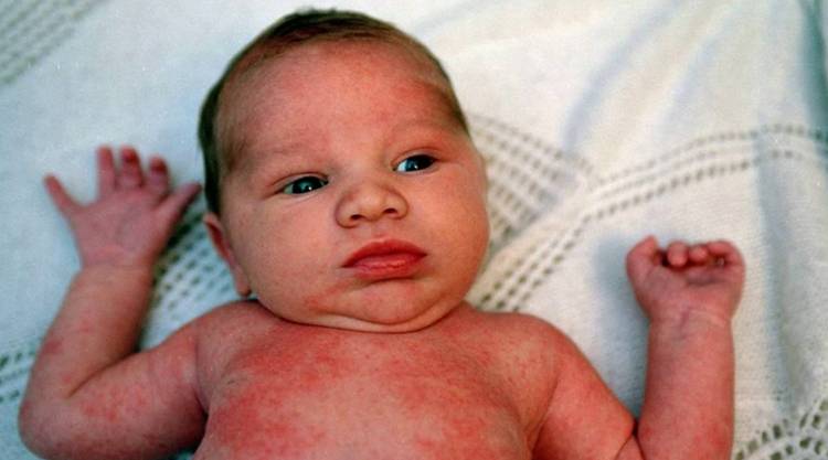 Проявление аллергии у малыша