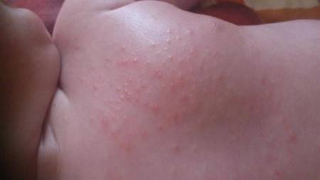 Аллергия на аквадетрим у грудничков чем заменить