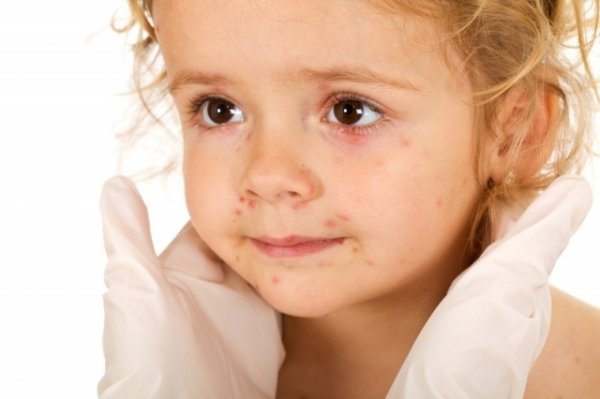 Аллергическая сыпь появляется практически у 60% детей