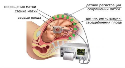 КТГ плода