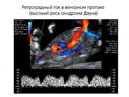 Риск синдрома Дауна на УЗИ