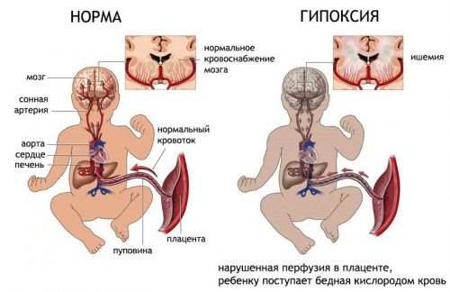 Гипоксия плода