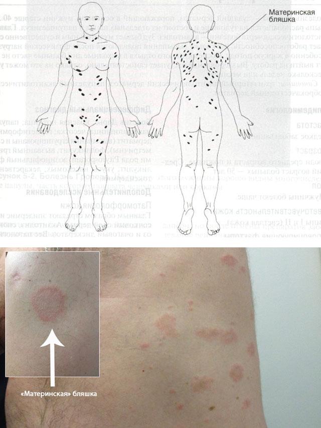 розовый лишай лечение