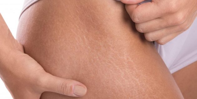 Как избавиться от растяжек: Растяжки