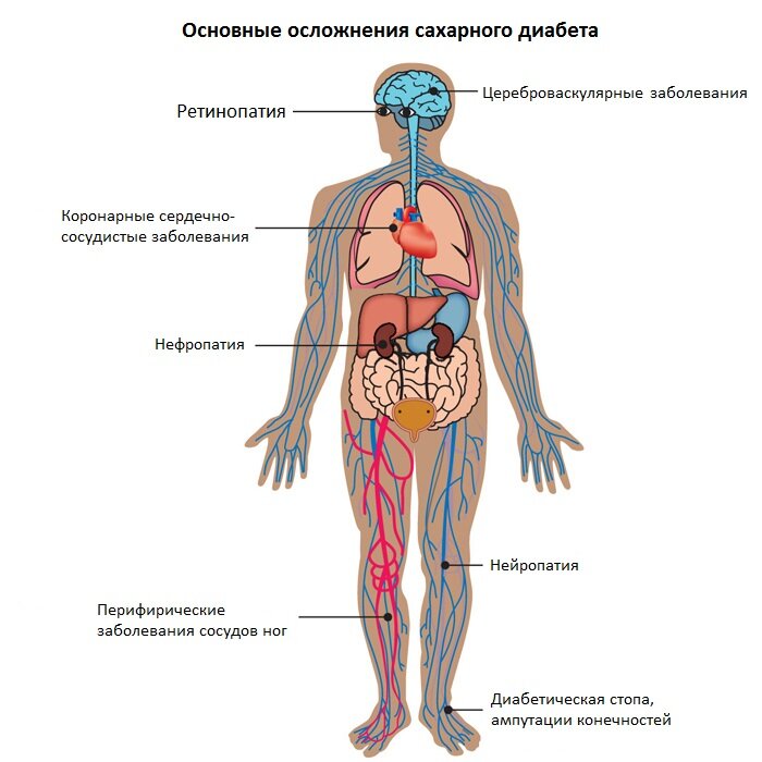 Осложнения сахарного диабета