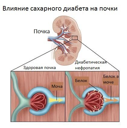 Влияние сахарного диабета на почки