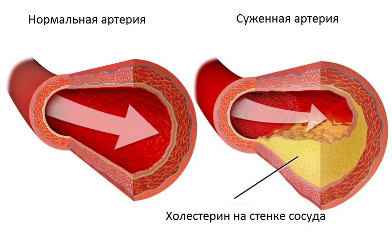 Осложнения диабета на сердце и сосуды