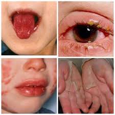 Болезнь кавасаки у детей и взрослых симптомы, фото фото