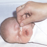 обработка носа новорожденного
