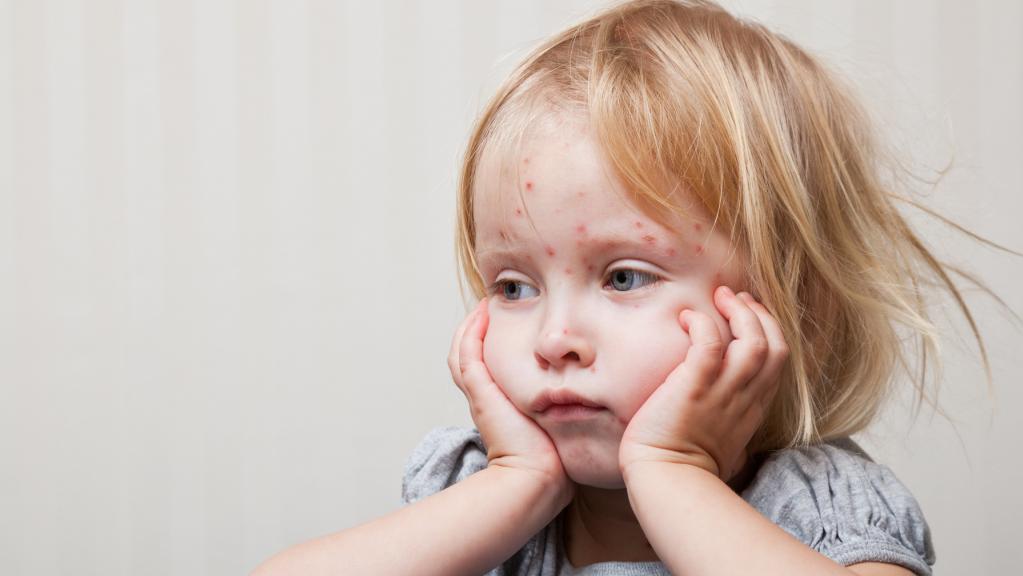 Как проявляется краснуха у детей симптомы
