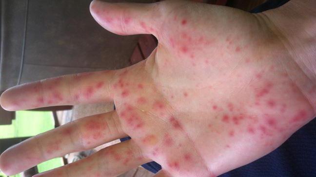 мазь от аллергии на холод на руках