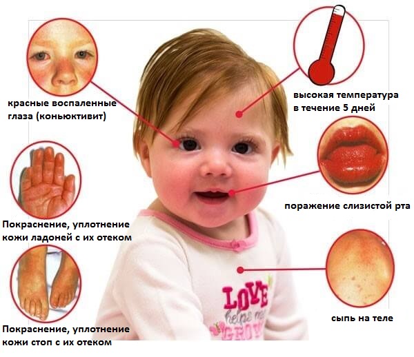 синдром кавасаки у детей фото