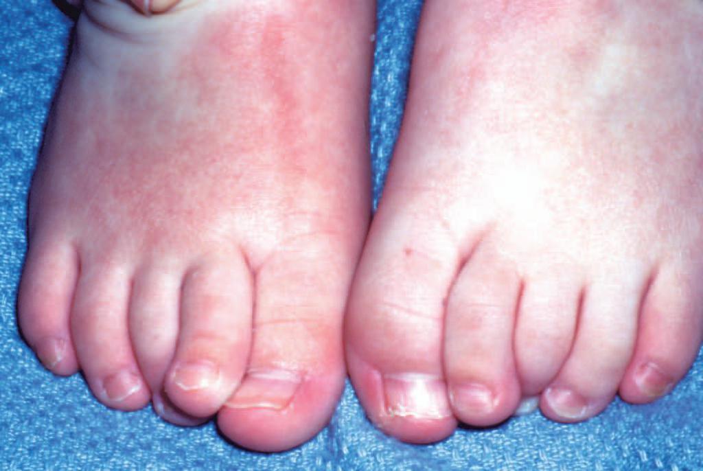 вросший ноготь у ребенка на ноге лечение