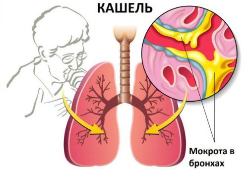 Влажный кашель Влажный кашель