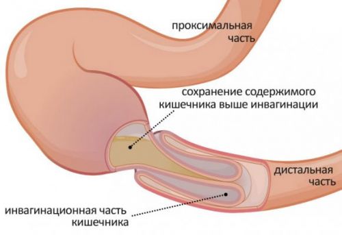  Инвагинация кишки