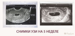 Размеры матки на 5 неделе беременности