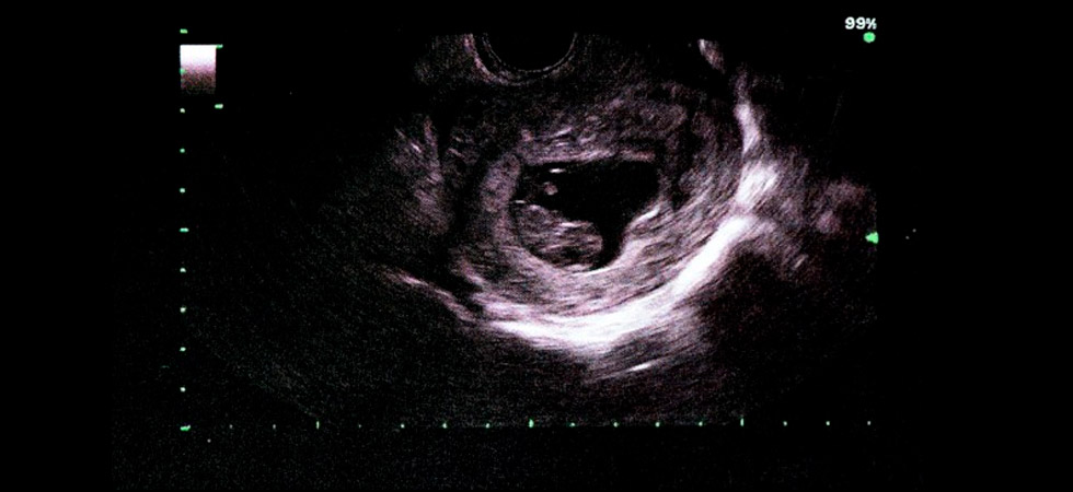УЗИ на 9 неделе беременности - фото
