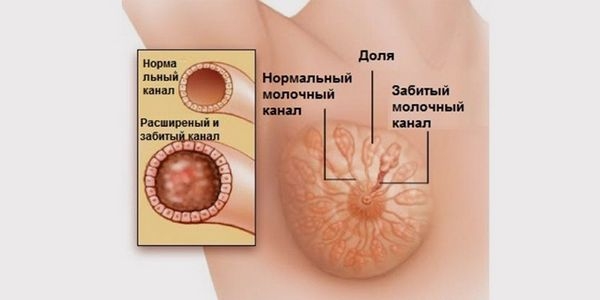 капустный лист при лактостазе