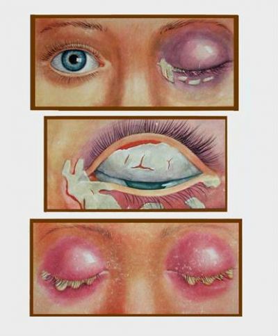 Дифтерия глаз