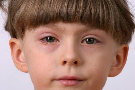 Воспаление глаз у ребенка