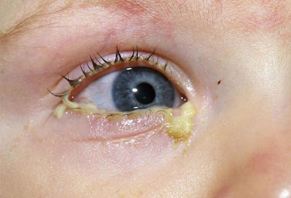 Бактериальное инфицирование глаза