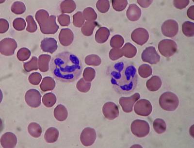 Сегментоядерные нейтрофилы в мазке крови