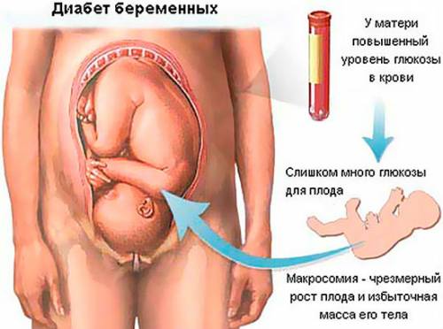 Диабет при беременности