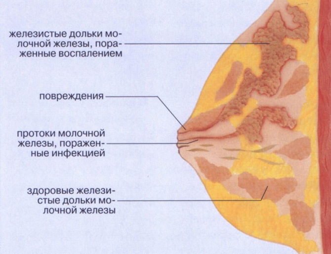 грудь с лактостазом в разрезе