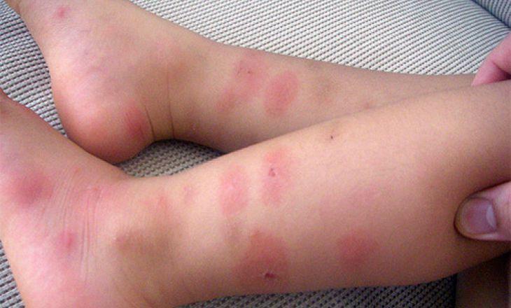 Аллергия и укусы насекомых – только часть причин высыпаний