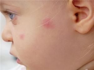 Причины красных пятен на лице у ребенка