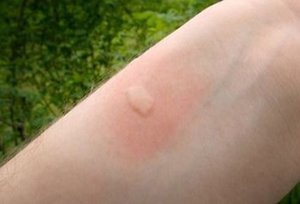 Как лечить укусы комарей