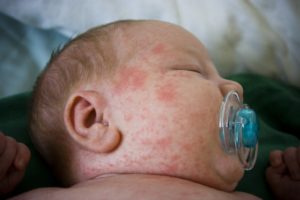 аллергия у новорожденных