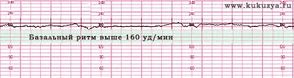 Кардиотокография (КТГ) при беременности