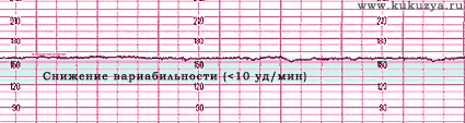 Кардиотокография (КТГ) при беременности