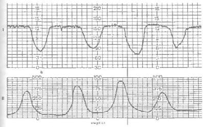 Кардиотокография (КТГ) при беременности