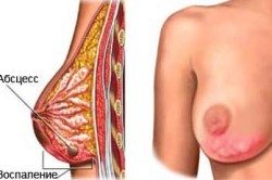 Профилактика заболеваний женской груди при помощи массажа