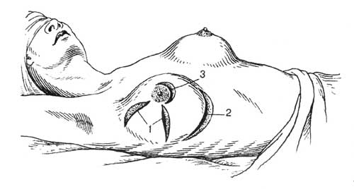 Разрезы на молочной железе в зависимости от локализации в ней абсцессов: 1 — радиальный; 2 — полулунный по нижней переходной складке; 3 — полуовальный, окаймляющий ареолу соска