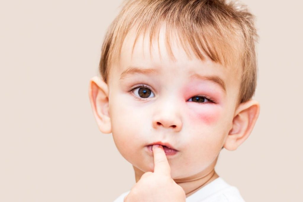 аллергия на лице у малыша