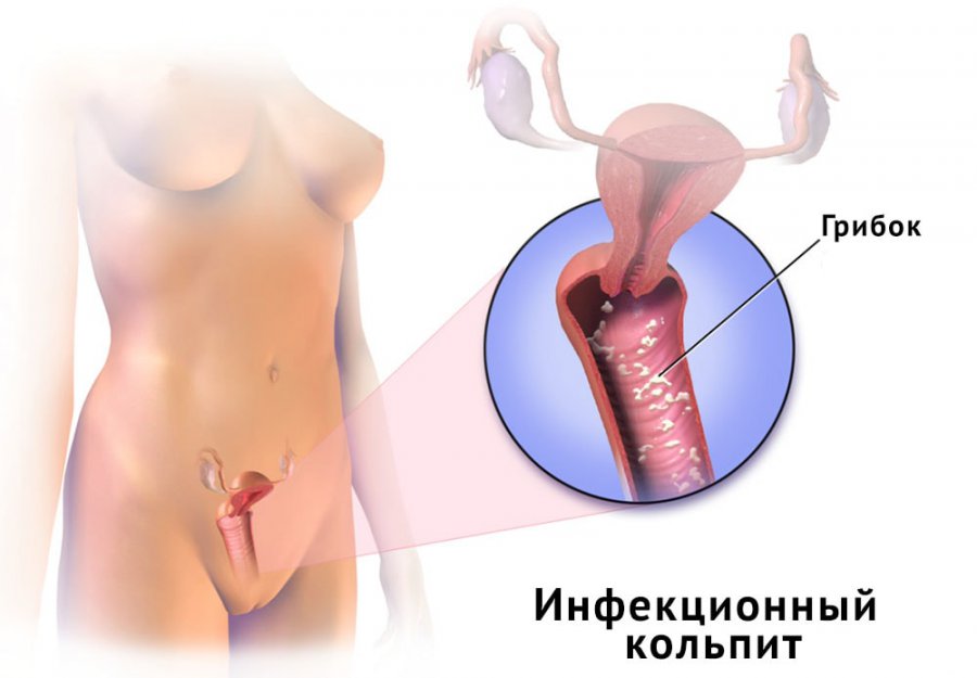 Кольпит