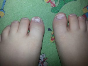 Мазь на ногтях пальцев ног