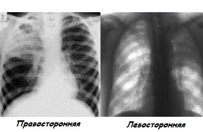 Схема лечения бронхопневмонии у телят