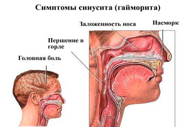 Симптомы синусита