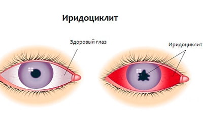 Иридоциклит
