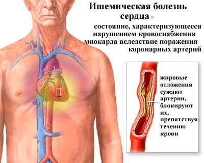 Ишемия сердца