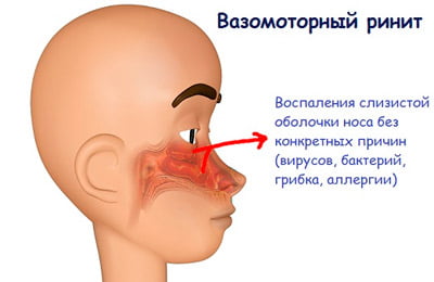 Вазомоторный ринит